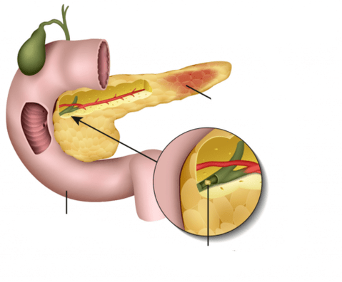 pancreatitis is an inflammation of the pancreas